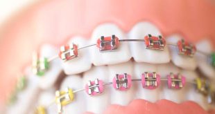 cute braces colors