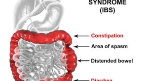 How to Deal with IBS