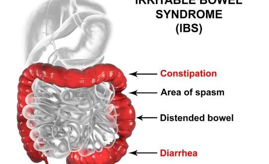 How to Deal with IBS